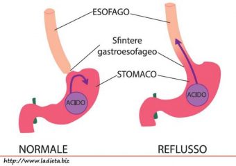 reflusso gastro esofageo